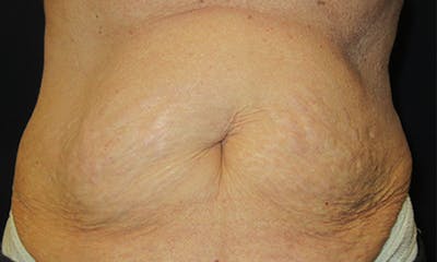 CoolSculpting Before & After Gallery - Patient 346122 - Image 1