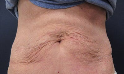 CoolSculpting Before & After Gallery - Patient 346122 - Image 2