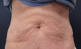 CoolSculpting Before & After Gallery - Patient 346122 - Image 2