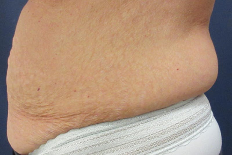 CoolSculpting Before & After Gallery - Patient 346122 - Image 3
