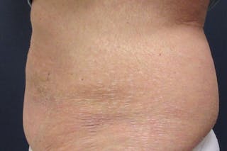 CoolSculpting Before & After Gallery - Patient 346122 - Image 4