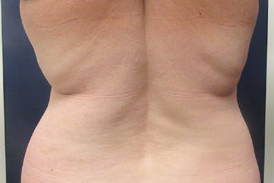 CoolSculpting Before & After Gallery - Patient 349214 - Image 1