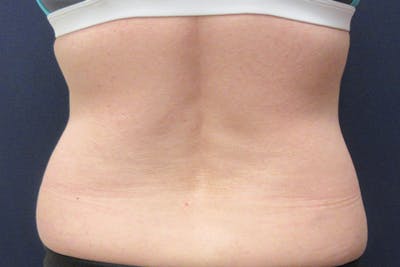 CoolSculpting Before & After Gallery - Patient 349214 - Image 2