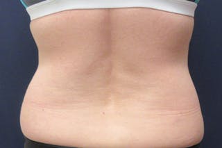 CoolSculpting Before & After Gallery - Patient 349214 - Image 2