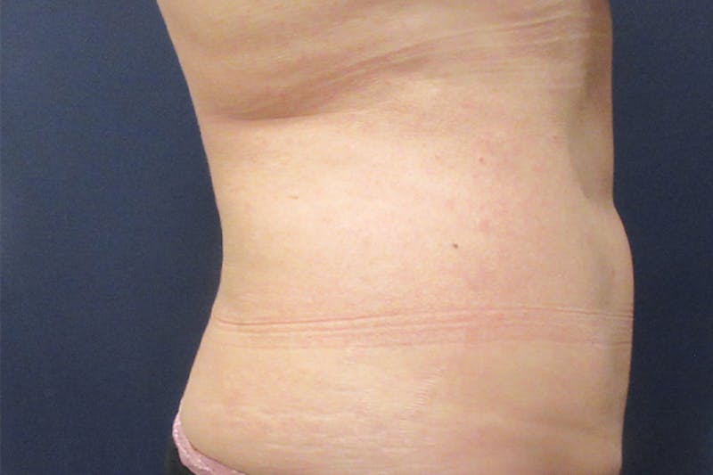 CoolSculpting Before & After Gallery - Patient 349214 - Image 3