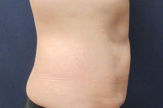 CoolSculpting Before & After Gallery - Patient 349214 - Image 4