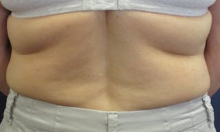 CoolSculpting Before & After Gallery - Patient 416032 - Image 2