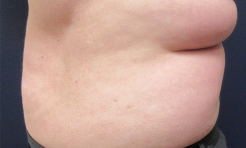 CoolSculpting Before & After Gallery - Patient 416032 - Image 3