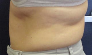 CoolSculpting Before & After Gallery - Patient 416032 - Image 4