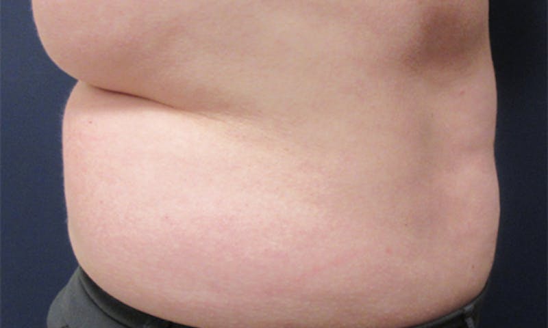 CoolSculpting Before & After Gallery - Patient 416032 - Image 5