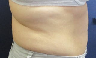 CoolSculpting Before & After Gallery - Patient 416032 - Image 6