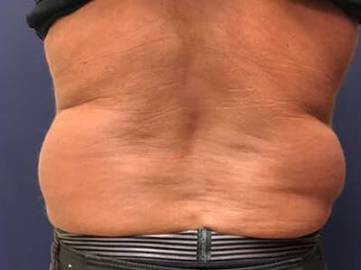 CoolSculpting Before & After Gallery - Patient 389997 - Image 1