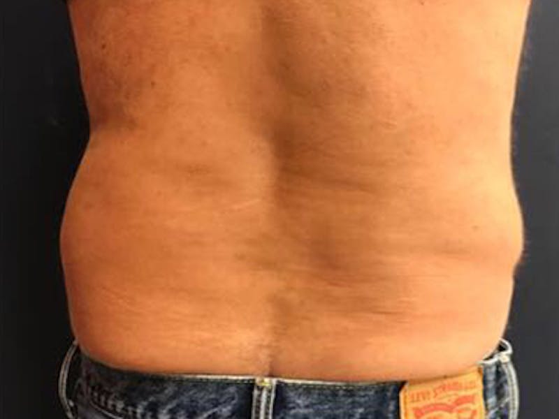 CoolSculpting Before & After Gallery - Patient 389997 - Image 2