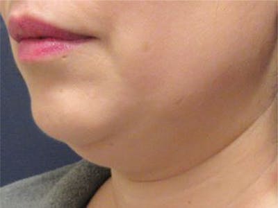 CoolSculpting Before & After Gallery - Patient 116909 - Image 1