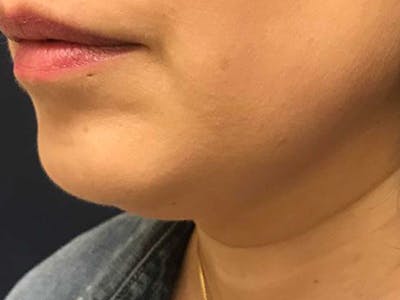 CoolSculpting Before & After Gallery - Patient 116909 - Image 2