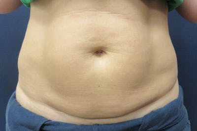 CoolSculpting Before & After Gallery - Patient 302567 - Image 1