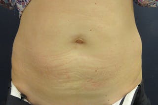 CoolSculpting Before & After Gallery - Patient 302567 - Image 2