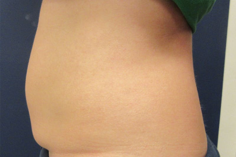 CoolSculpting Before & After Gallery - Patient 302567 - Image 3