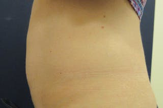 CoolSculpting Before & After Gallery - Patient 302567 - Image 4