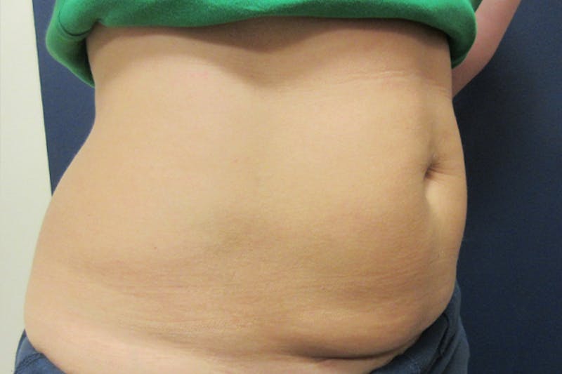 CoolSculpting Before & After Gallery - Patient 302567 - Image 5