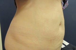 CoolSculpting Before & After Gallery - Patient 302567 - Image 6