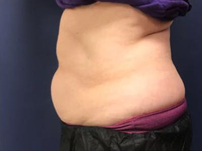 CoolSculpting Before & After Gallery - Patient 320176 - Image 1