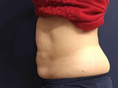 CoolSculpting Before & After Gallery - Patient 320176 - Image 2