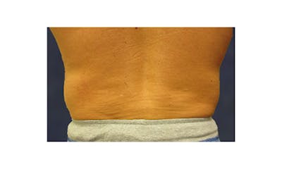 CoolSculpting Before & After Gallery - Patient 266566 - Image 1