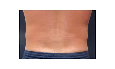 CoolSculpting Before & After Gallery - Patient 266566 - Image 2