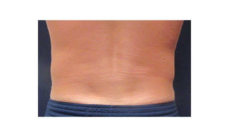 CoolSculpting Before & After Gallery - Patient 266566 - Image 2