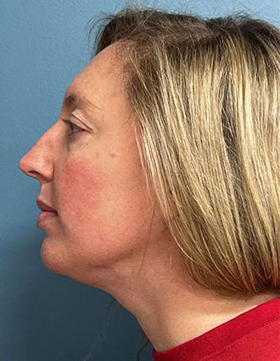 Liposuction Before & After Gallery - Patient 102309 - Image 2