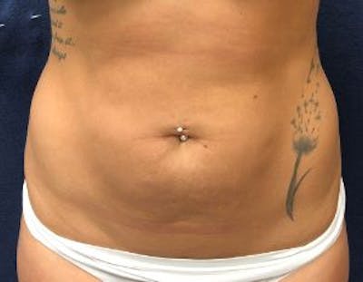 Liposuction Before & After Gallery - Patient 292372 - Image 1