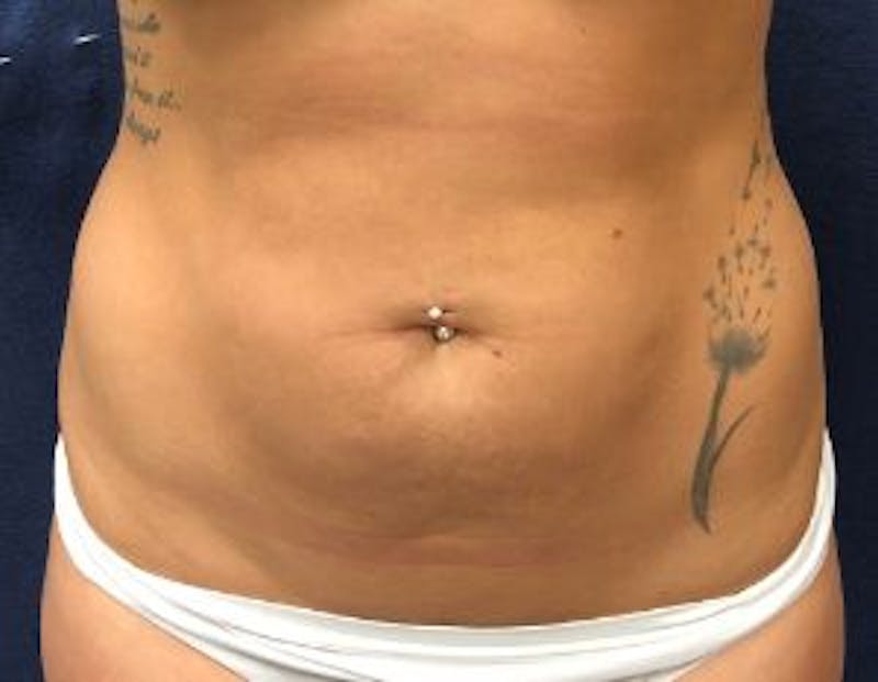 Liposuction Before & After Gallery - Patient 292372 - Image 1