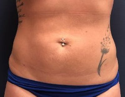 Liposuction Before & After Gallery - Patient 292372 - Image 2