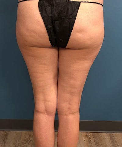Liposuction Before & After Gallery - Patient 205752 - Image 1