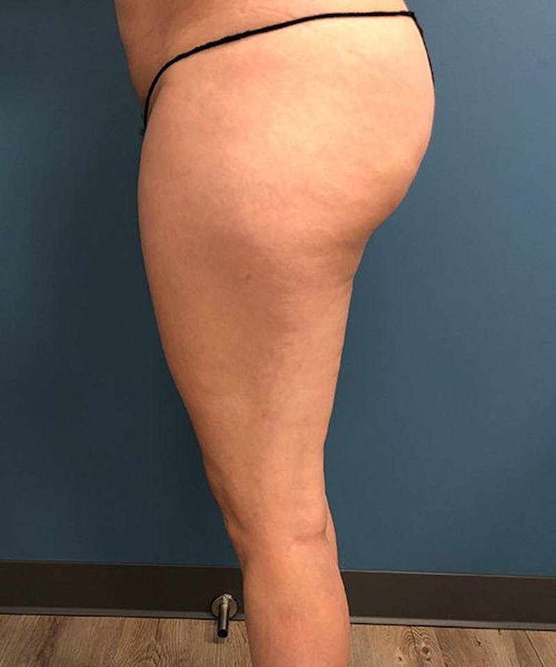 Liposuction Before & After Gallery - Patient 205752 - Image 3
