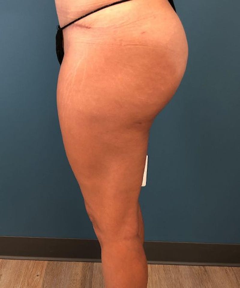 Liposuction Before & After Gallery - Patient 205752 - Image 4