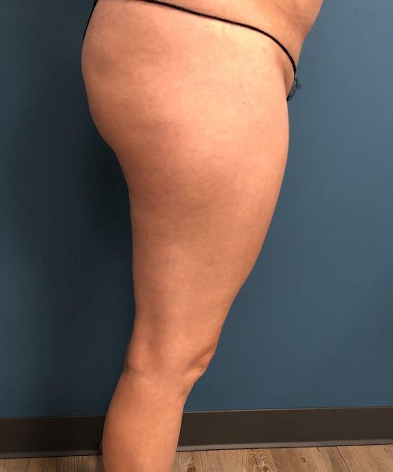Liposuction Before & After Gallery - Patient 205752 - Image 5