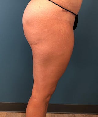 Liposuction Before & After Gallery - Patient 205752 - Image 6