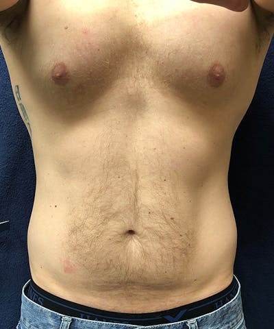 Liposuction Before & After Gallery - Patient 289085 - Image 1