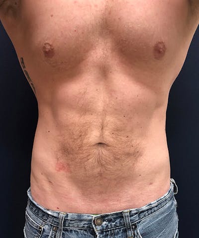 Liposuction Before & After Gallery - Patient 289085 - Image 2
