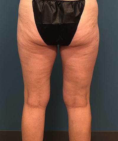 Liposuction Before & After Gallery - Patient 668083 - Image 2