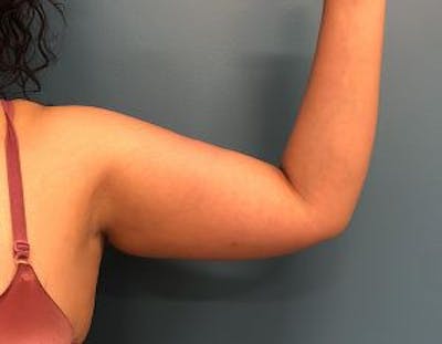 Liposuction Before & After Gallery - Patient 189828 - Image 1
