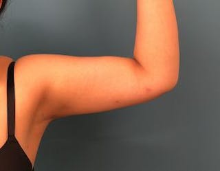 Liposuction Before & After Gallery - Patient 189828 - Image 2