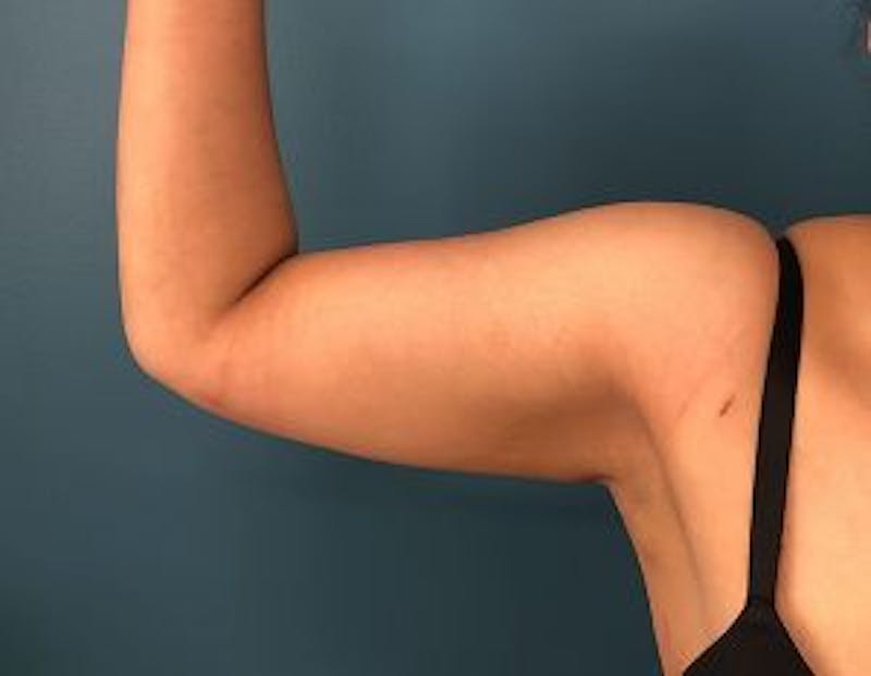 Liposuction Before & After Gallery - Patient 189828 - Image 4