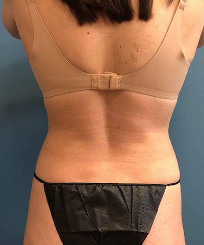 Liposuction Before & After Gallery - Patient 317771 - Image 2