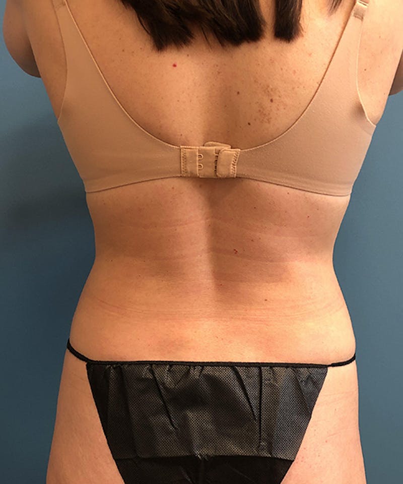 Liposuction Before & After Gallery - Patient 317771 - Image 2