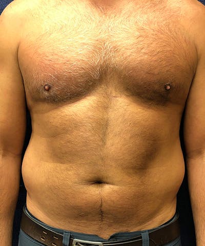 Liposuction Before & After Gallery - Patient 378185 - Image 1