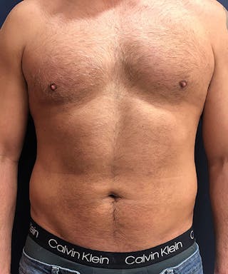 Liposuction Before & After Gallery - Patient 378185 - Image 2