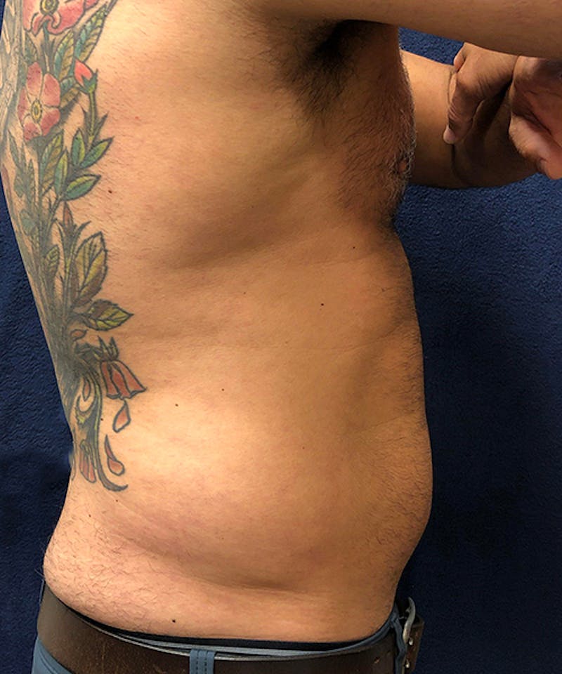 Liposuction Before & After Gallery - Patient 378185 - Image 3